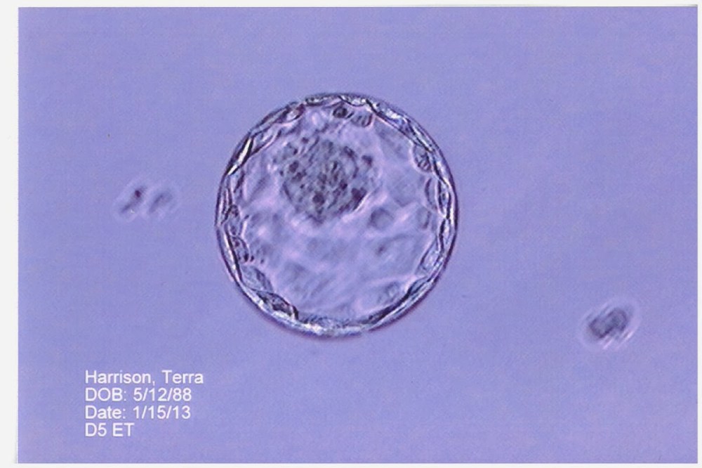 1.15.13 Embryo Transferred