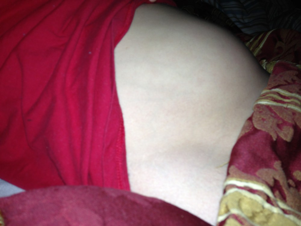 1.15.13 OHSS (Post-Egg Retrieval)