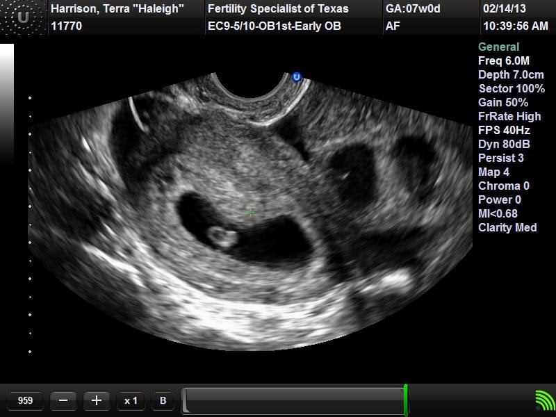2.14.13 Sonogram (Yolk Sac)